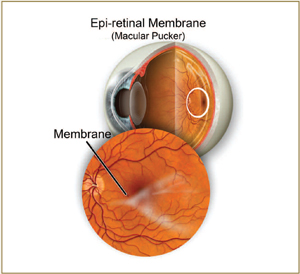 macular-pucker2