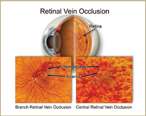 occlusion