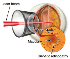 retinopathy