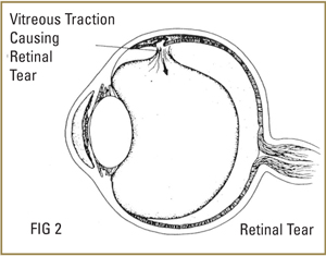 vitreous-tesar